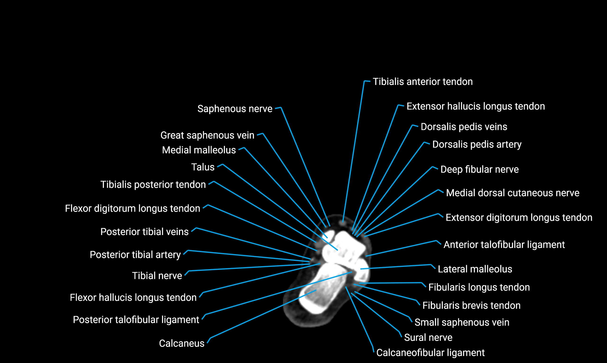 CT lower limb axial cross sectional anatomy labelled image 168 (2).webp